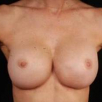 Aesthetic Breast Revision - Case #9 After