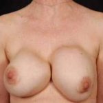 Aesthetic Breast Revision - Case #13 Before