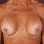 Aesthetic Breast Revision - Case #16 Before