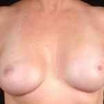 Aesthetic Breast Revision - Case #22 After