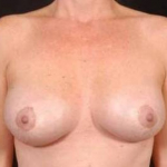 Aesthetic Breast Revision - Case #25 After