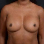 Aesthetic Breast Revision - Case #29 Before