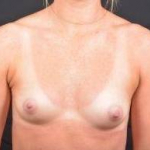 Breast Augmentation Silicone Gel - Case #61 Before