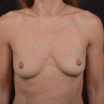 Breast Augmentation Silicone Gel - Case #42 Before