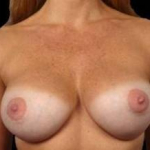 Breast Augmentation Silicone Gel - Case #7 After