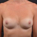 Breast Augmentation Silicone Gel - Case #17 After
