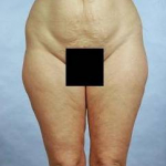 Liposuction - Case #1 Before