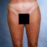 Liposuction - Case #1 After