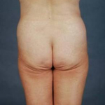 Liposuction - Case #3 Before