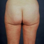 Liposuction - Case #5 After