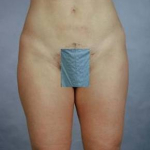 Liposuction - Case #7 After