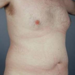 Liposuction - Case #11 Before