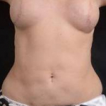 Liposuction - Case #12 After