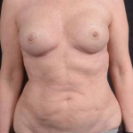 Liposuction - Case #14 Before