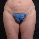 Liposuction - Case #14 After