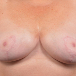 Breast Revision - Case #63 After