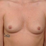 Breast Augmentation Silicone Gel- Case BASG-98 Before