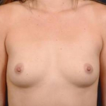 Breast Augmentation Silicone Gel- Case BASG-99 Before