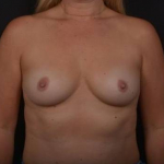 Breast Augmentation - Case #104 Before