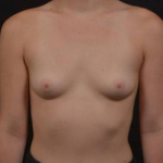 Breast Augmentation - Case #108 Before