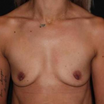 Breast Augmentation - Case #115 Before