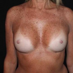 Breast Augmentation - Case #116 After