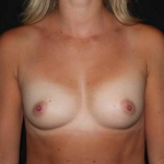 Breast Augmentation - Case #119 Before