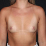 Breast Augmentation - Case #222 Before