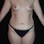 Liposuction - Case #32 Before