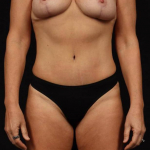 Liposuction - Case #38 After