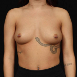Breast Augmentation - Case #122 Before