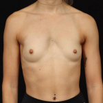 Breast Augmentation - Case #124 Before