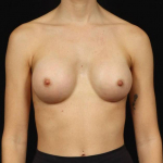Breast Augmentation - Case #124 After