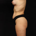 Liposuction - Case #186 After