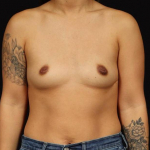Breast Augmentation - Case #153 Before