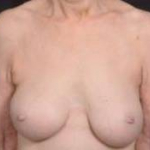 Breast Augmentation Mastopexy Revision - Case #39 Before