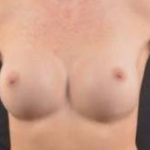 Aesthetic Breast Revision - Case #36 Before