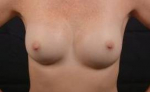 Aesthetic Breast Revision - Case #36 After