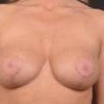 Aesthetic Breast Revision - Case #34 Before