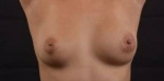 Breast Revision - Case #45 Before