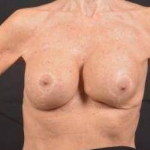 Aesthetic Breast Revision - Case #31 Before