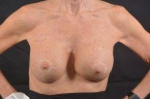 Aesthetic Breast Revision - Case #31 After