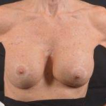 Aesthetic Breast Revision - Case #31 After