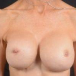 Aesthetic Breast Revision - Case #30a Before