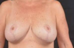 Breast Revision - Case #33 Before