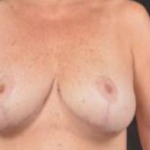 Breast Revision - Case #33 Before