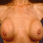 Aesthetic Breast Revision - Case #1 Before