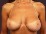 Aesthetic Breast Revision - Case #1 After