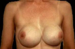 Aesthetic Breast Revision - Case #3 Before