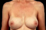 Aesthetic Breast Revision - Case #3 After